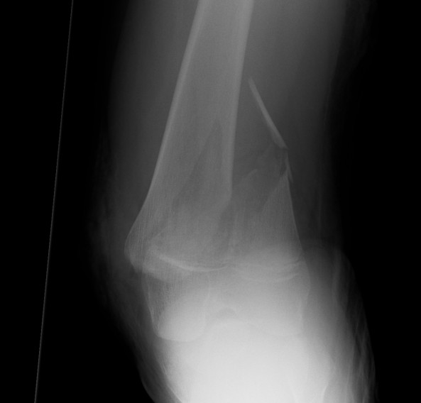 SH2 Distal Femoral Fracture AP